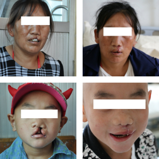 Des patients venus de villages éloignés, avant et après leur chirurgie pour corriger leur bec de lièvre.