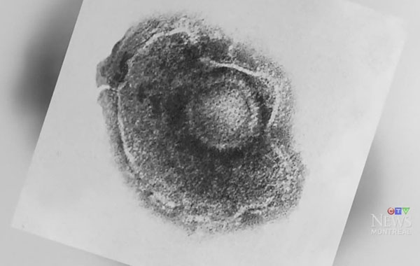 Le Québec devrait-il étendre la vaccination gratuite contre le zona à un plus grand nombre de personnes?