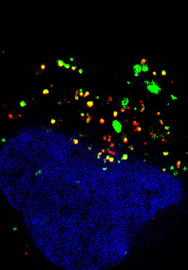 Une cellule cancéreuse du cerveau (noyau en bleu) reçoit des messages de deux autres cellules via des vésicules extracellulaires ou VE (en vert et rouge).