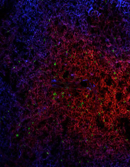 Ganglion lymphatique à l’intérieur duquel on peut observer des lymphocytes T normaux (en rouge) et des Treg régulées par le gène FOXP3 gene (en verts).