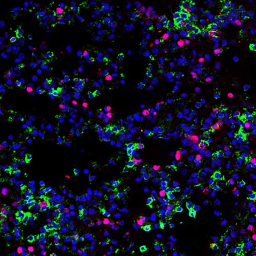 En l’absence de la signalisation de LTB4, une partie des macrophages inflammatoires (en vert) prolifèrent dans les poumons (marqueur de prolifération en rouge), contribuant ainsi à l’inflammation pulmonaire. Les noyaux des cellules sont en bleu. (Microscopie confocale réalisée par Erwan Pernet, IR-CUSM