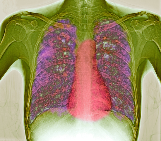 Radiographie thoracique (rayons X colorés) montrant les poumons d’un patient infecté par la tuberculose (tissus infectés en rose).